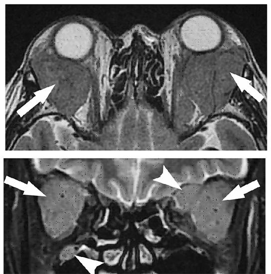【裁断】唾液腺疾患のMRI メジカルビュー社｜画像医学・放射線医学｜唾液腺疾患のMRI