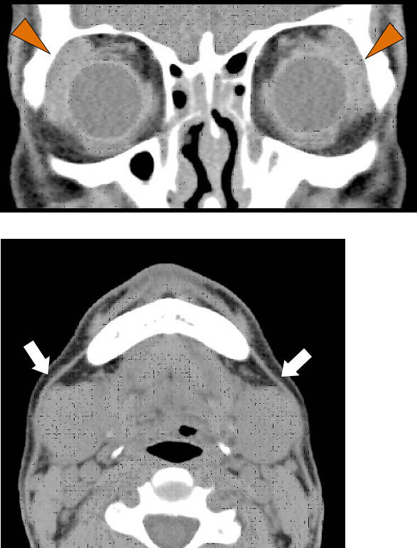 [A12160207]唾液腺疾患のMRI